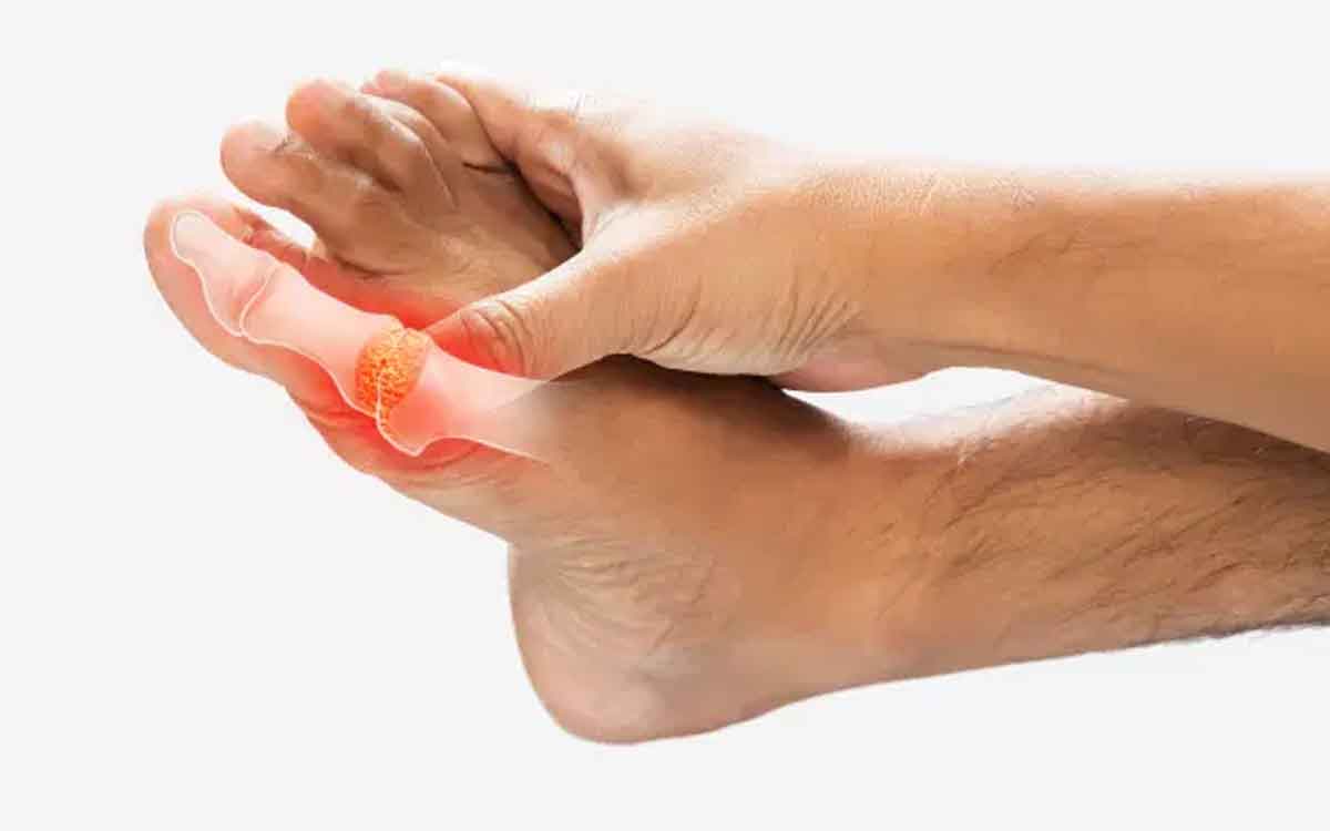 Uric Acid Levels | యూరిక్ యాసిడ్ లెవ‌ల్స్ అధికంగా ఉన్నాయా..? గౌట్ బాధిస్తుందా..? ఈ చిట్కాల‌ను పాటించండి..!