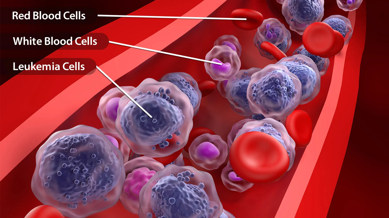 AML | యువతలో పెరుగుతున్న అక్యూట్‌ మైలోయిడ్‌ లుకేమియా..! ఈ క్యాన్సర్‌ లక్షణాలు ఇవే..!