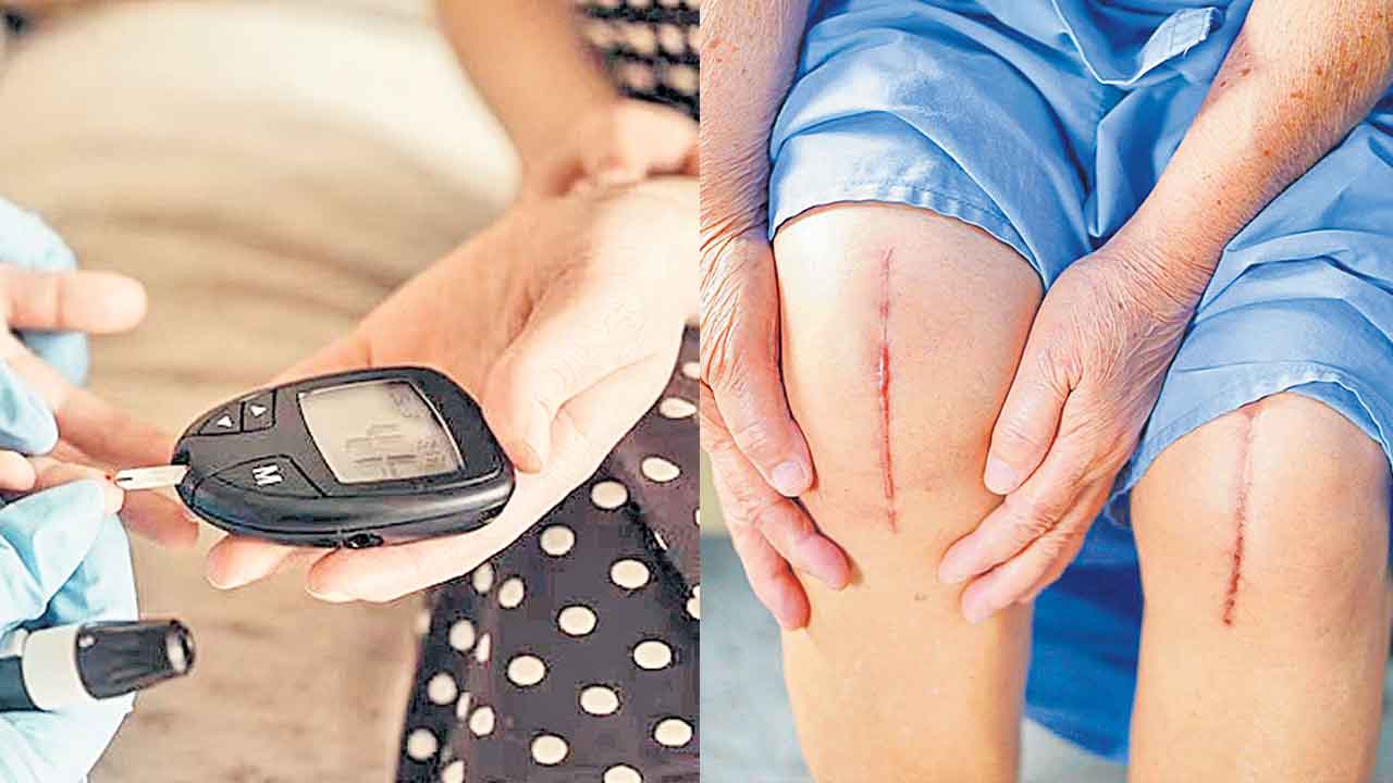 కీళ్ల మార్పిడి తర్వాత మధుమేహంతో ఇన్ఫెక్షన్‌, రక్తం గడ్డకట్టే ముప్పు