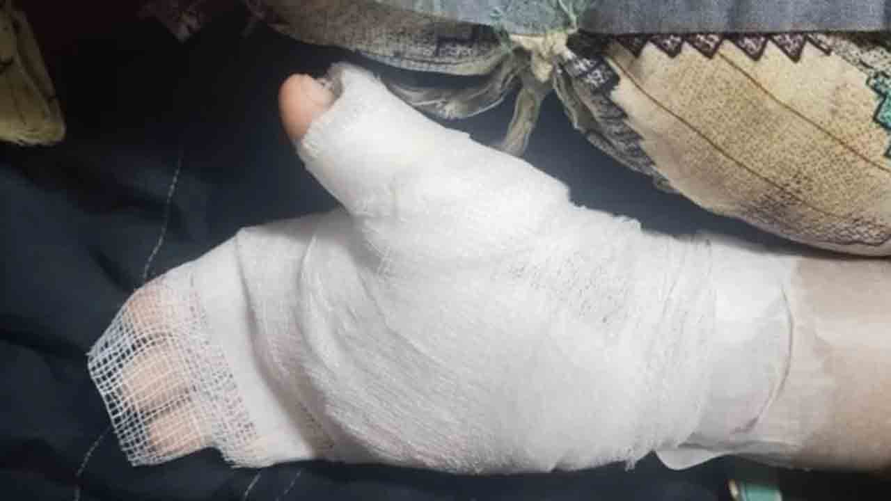 Mumbai Teacher | దారుణం.. చేతిరాత సరిగా లేదని క్యాండిల్‌తో బాలుడి చేయి కాల్చిన టీచర్‌