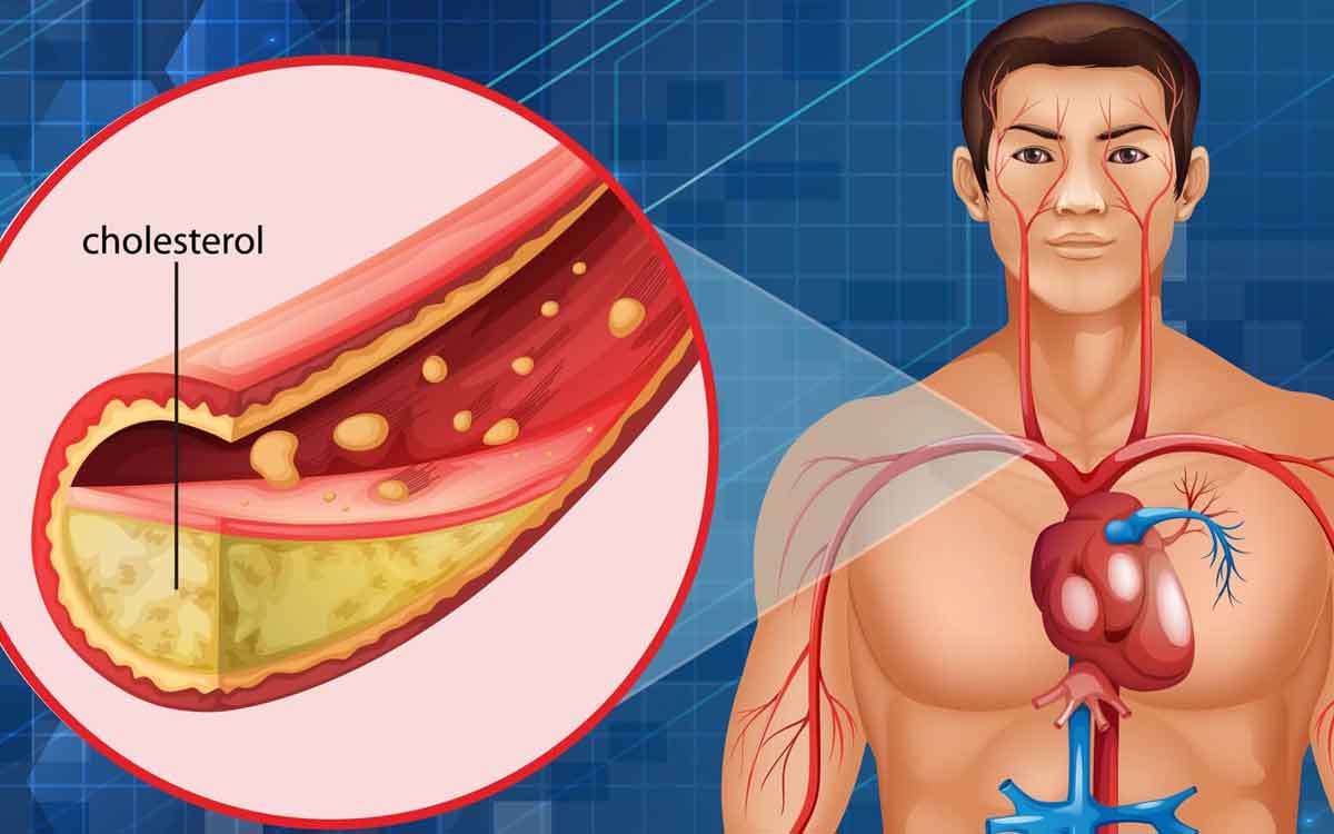 High Cholesterol Symptoms | ఈ ల‌క్ష‌ణాలు క‌నిపిస్తున్నాయా..? అయితే మీ శ‌రీరంలో కొలెస్ట్రాల్ అధికంగా ఉంద‌ని అర్థం.. జాగ్ర‌త్త ప‌డాల్సిందే..!