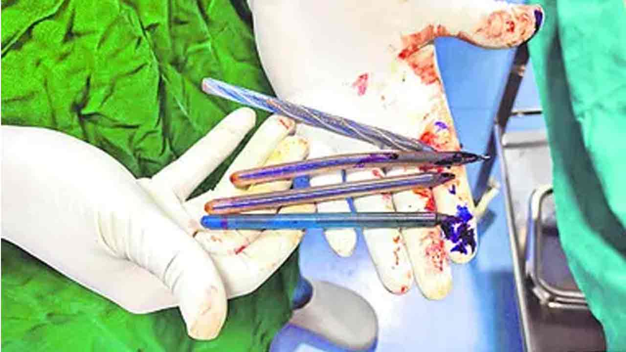 Viral News | భర్త మీద కోపంతో పెన్నులు మింగేసిన భార్య.. ఏపీలో వింత ఘటన