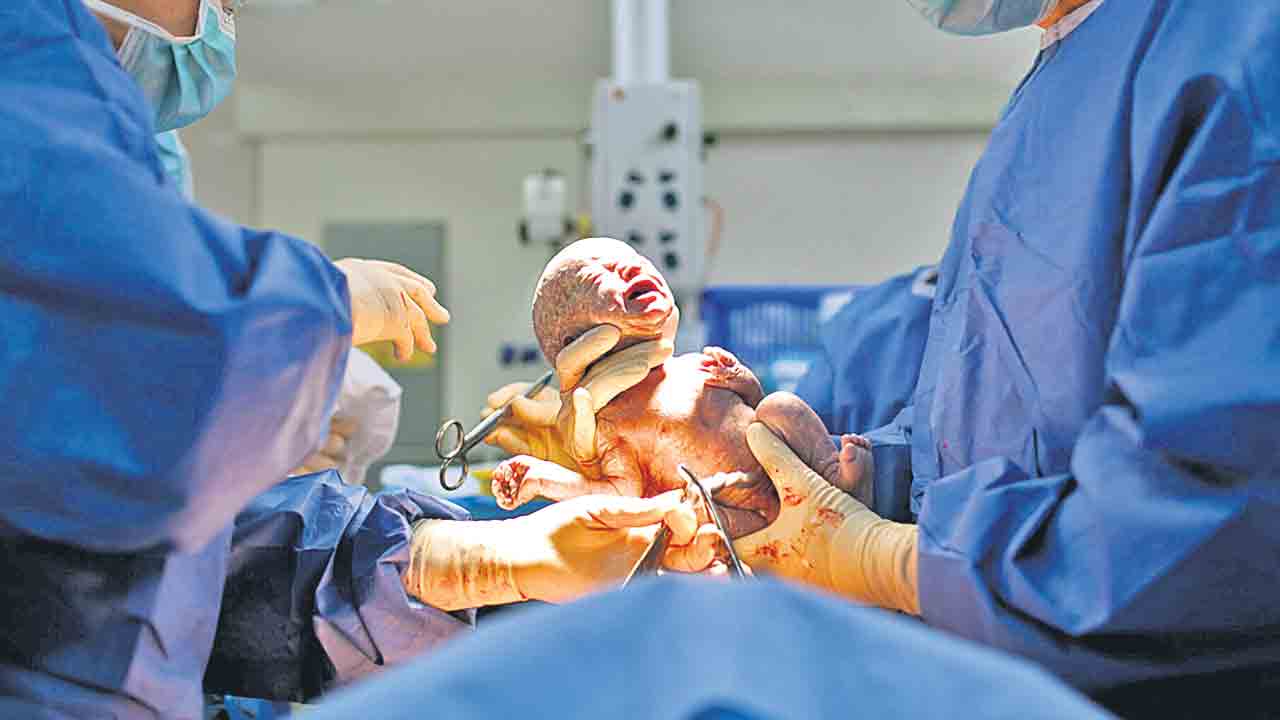 సిజేరియన్లతో జేబుకు కోత.. 2024-25లో రాష్ట్రంలో 3,05,944 సిజేరియన్‌ డెలివరీలు