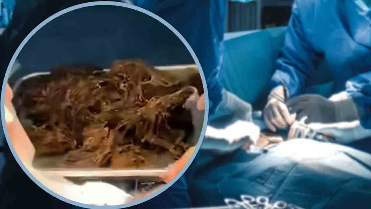 బాలిక కడుపులో 2 కిలోల వెంట్రుకల ఉండ