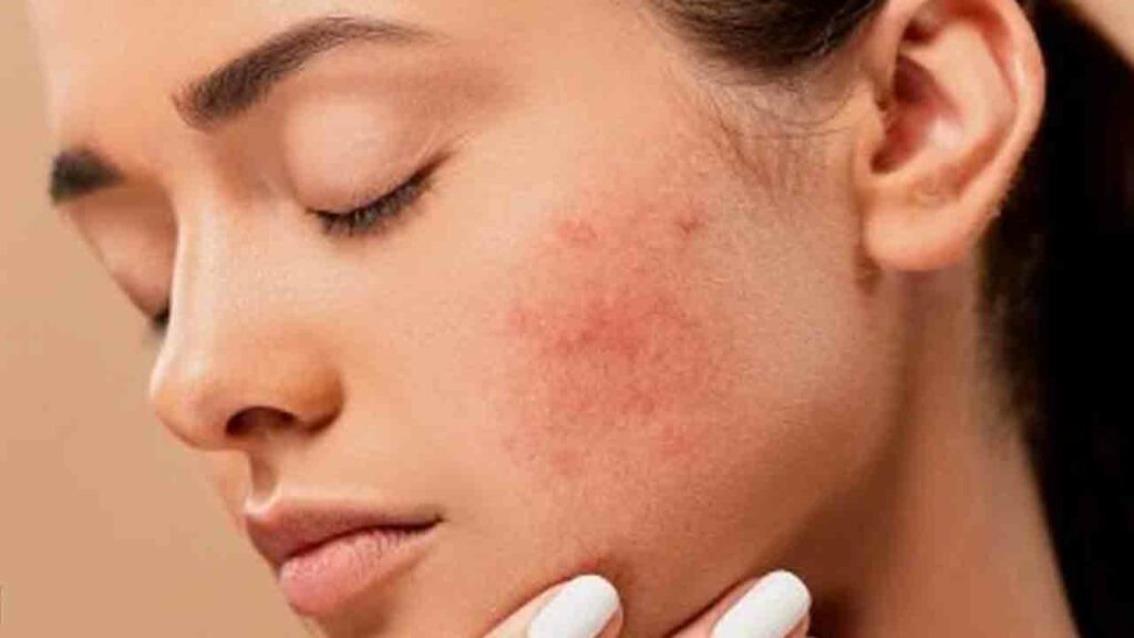 Pimples Reducing Tips
