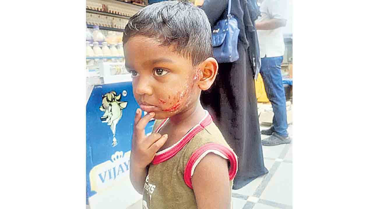 బాలుడిపై వీధికుక్కల దాడి