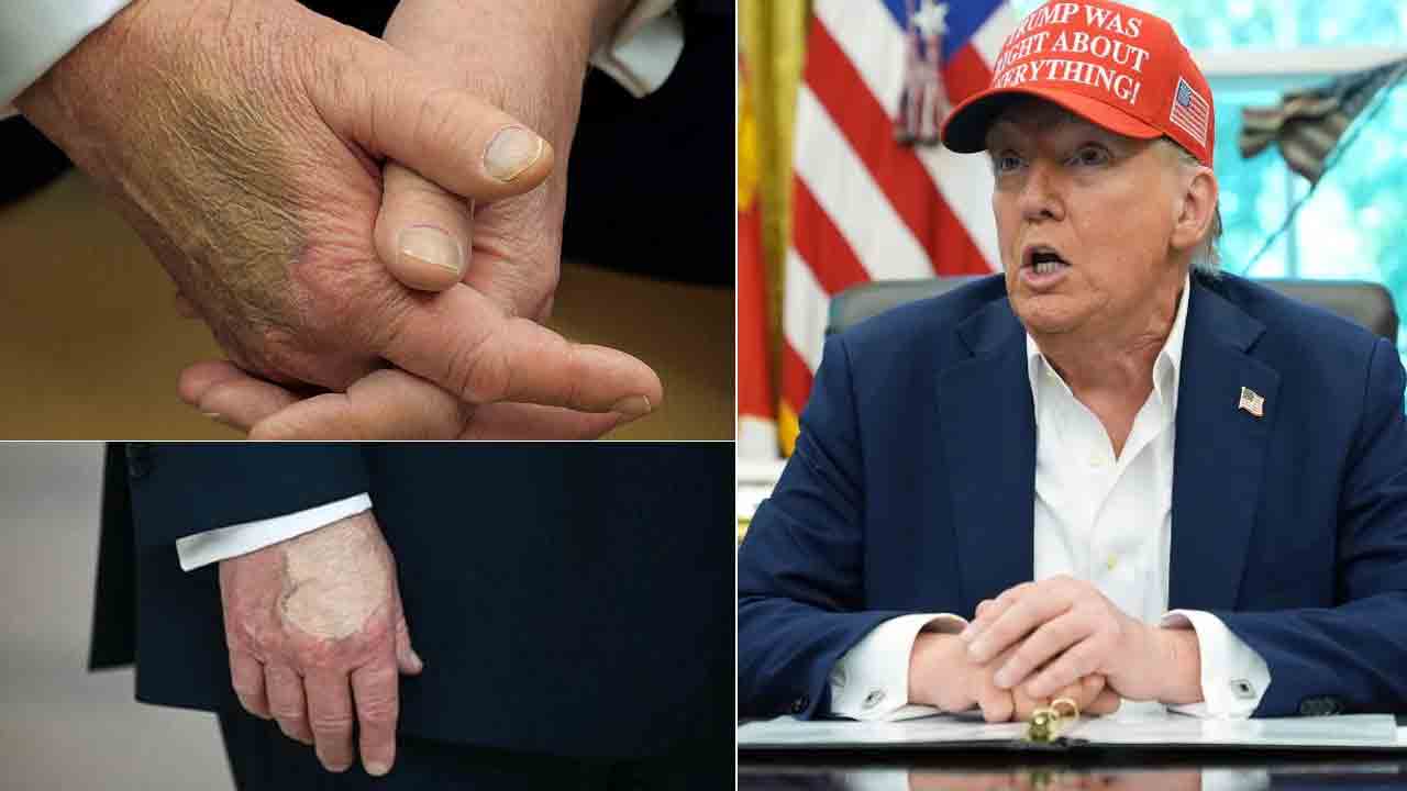Donald Trump | ట్రంప్ కుడిచేతిపై మిస్టీరియస్ మార్క్స్.. అధ్యక్షుడి ఆరోగ్యంపై ఊహాగానాలు