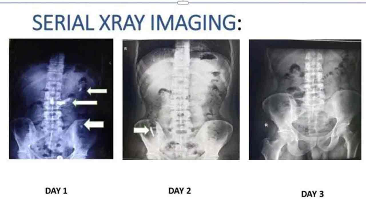 Hyderabad | 7 బ్లేడ్లను మింగిన ఆటోడ్రైవర్‌.. మ‌ల‌ద్వారం నుంచి బయటకు తీసిన గాంధీ వైద్యులు
