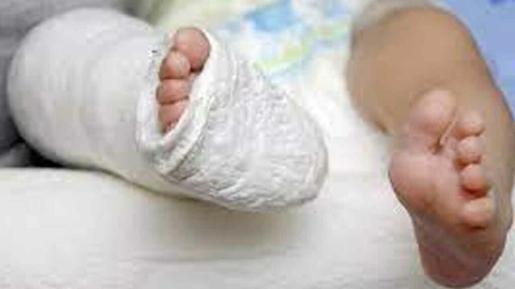 Childrens, Fractures