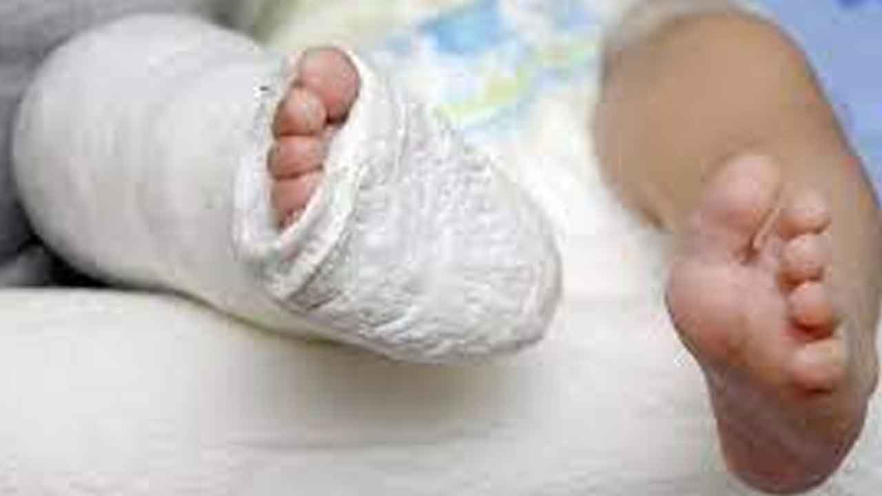 రోజుల పాపకు ఫ్రాక్చరా?