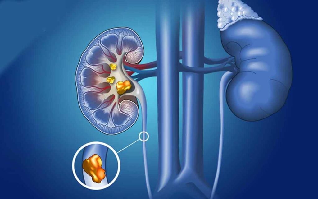 Kidney Stones