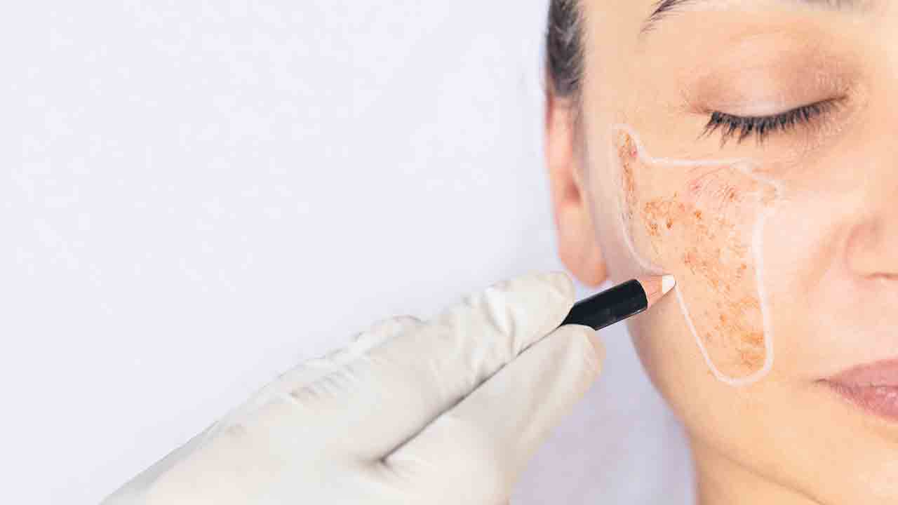 రూపానికి ప్రతిరూపం.. పాస్టిక్‌ సర్జరీతో గాయాలు మాయం