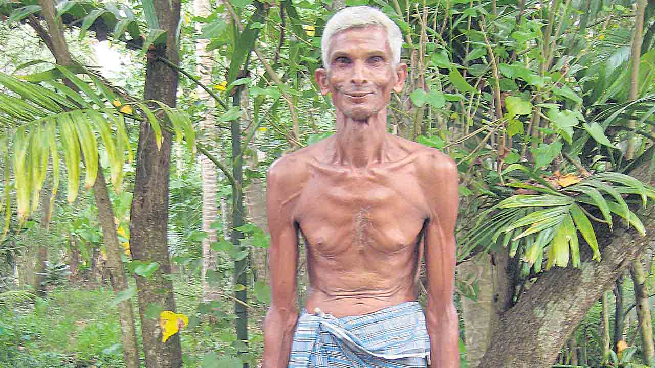 బాగా సన్నబడ్డా ప్రమాదమే.. అధిక బరువు కన్నా ఎక్కువ ముప్పు