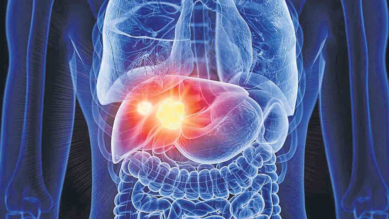 ఫ్యాటీ లివర్‌కు తొలి ఔషధం!