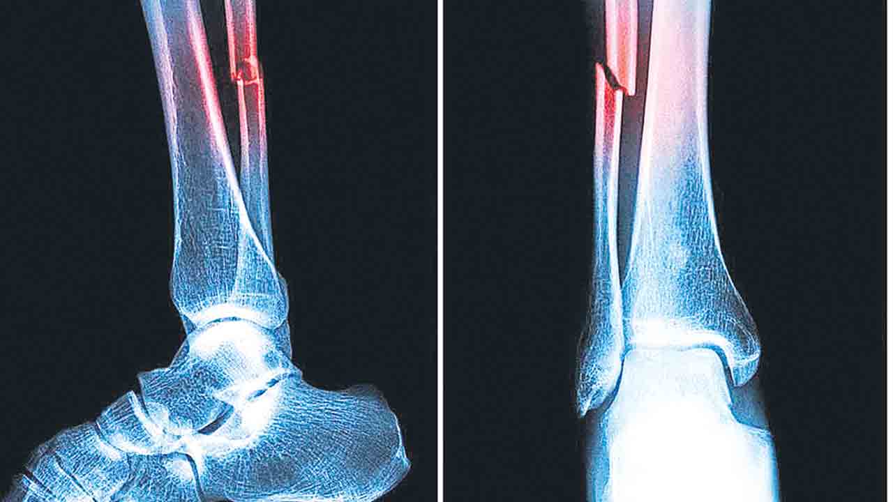 మూడు నిమిషాల్లో ఎముకలు అతికేలా సూది మందు