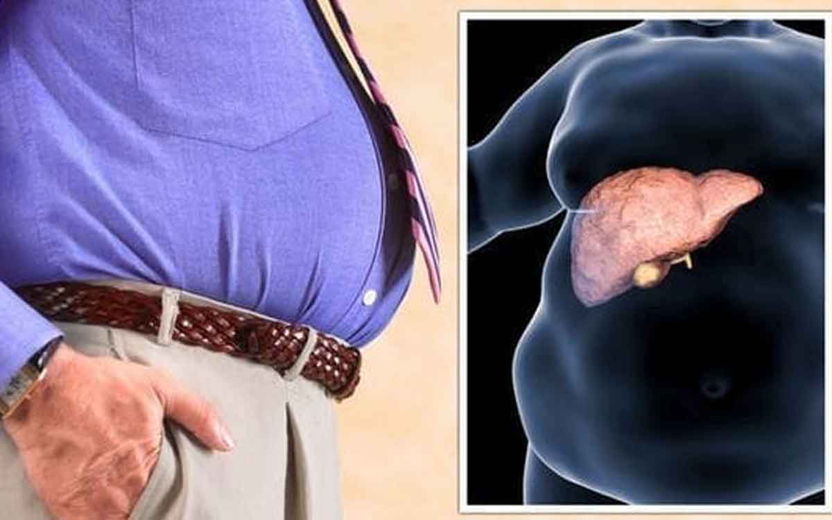 Fatty Liver Symptoms | ఫ్యాటీ లివర్ ఉన్నవారిలో కనిపించే లక్షణాలు ఏమిటి..? ఎలాంటి ఆహారాలను తీసుకోవాలి..?