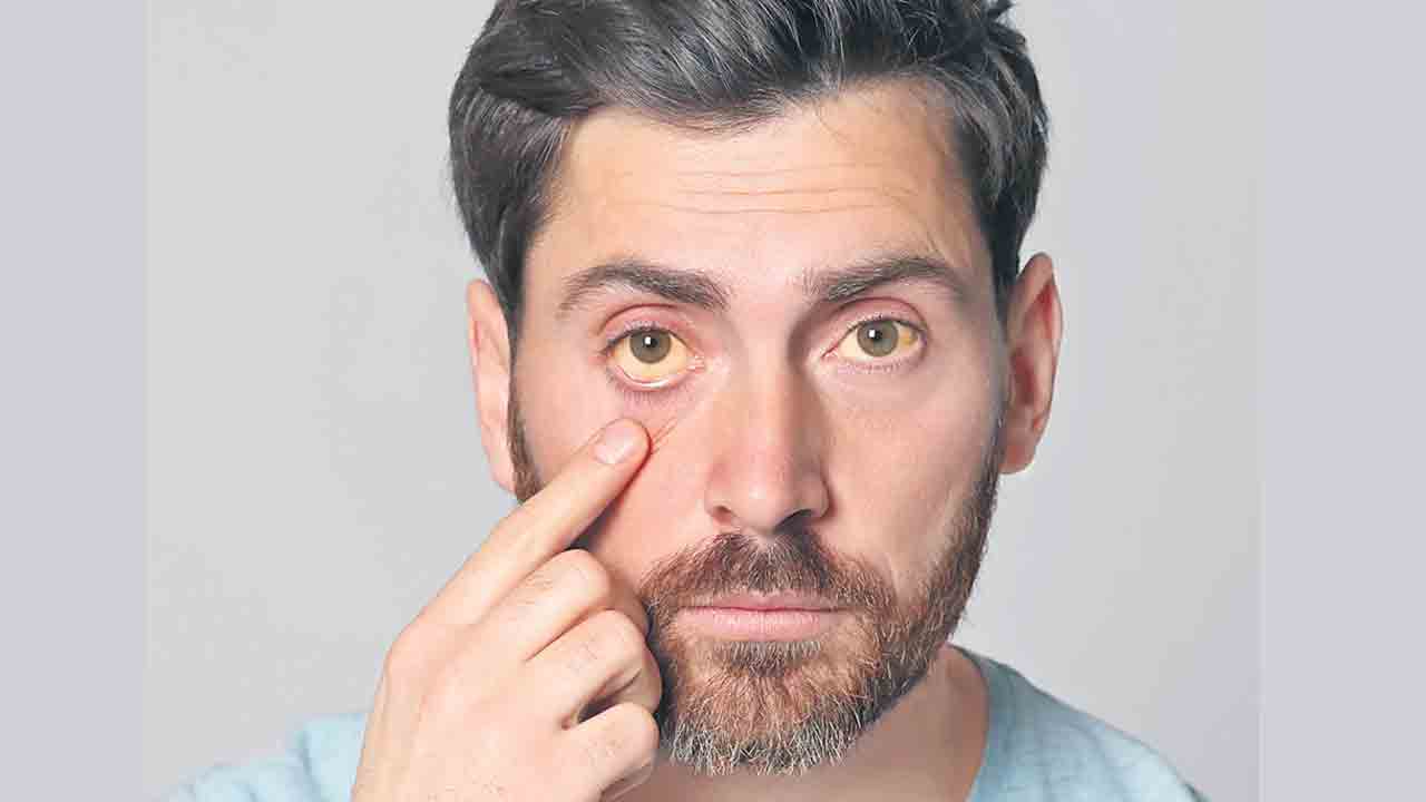 Jaundice 1