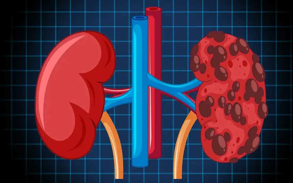 Kidneys Damage