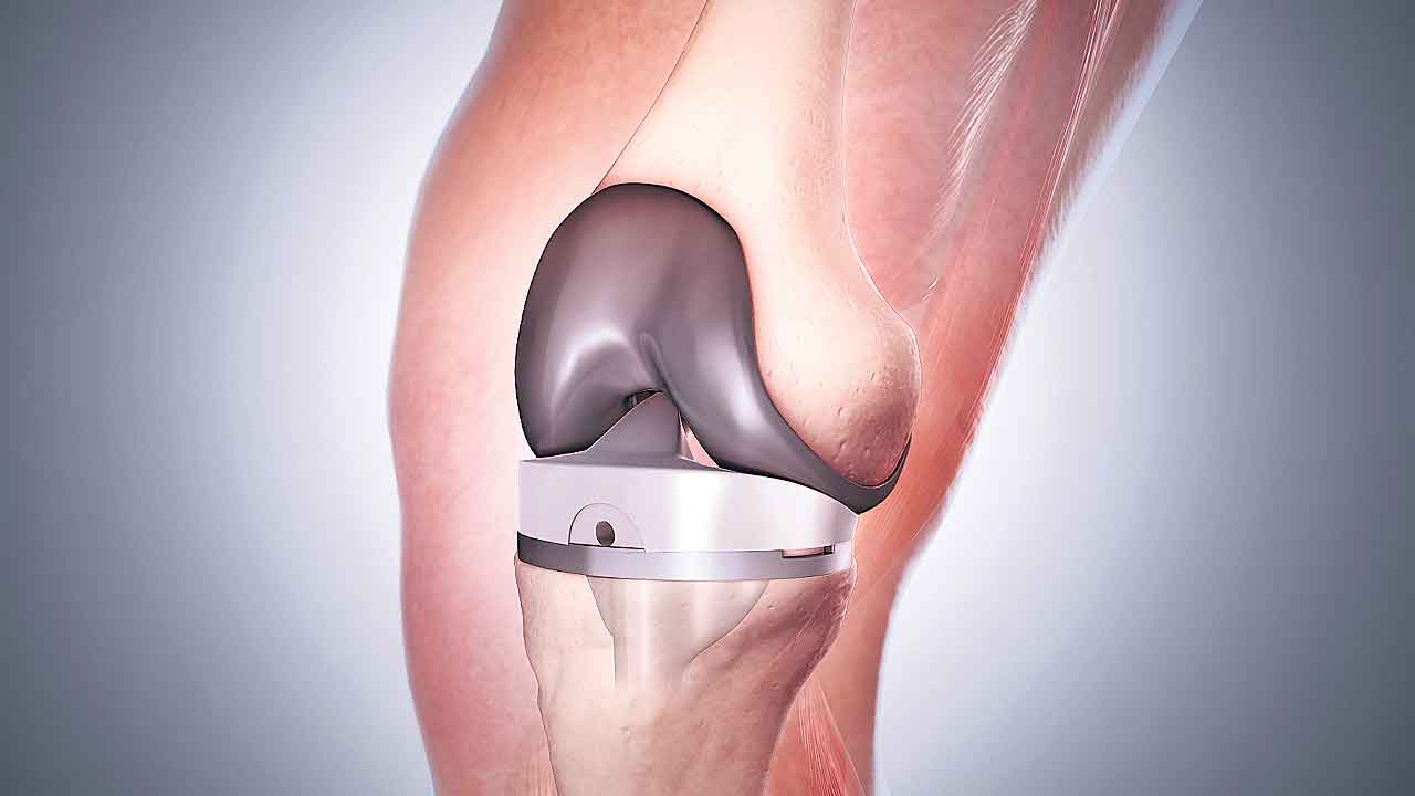 Knee Replacement 3