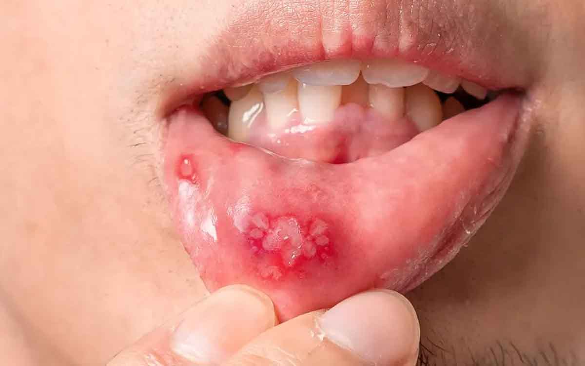Mouth Ulcers | నోట్లో పుండ్లు ఏర్ప‌డి ఇబ్బందిగా ఉందా..? అయితే ఈ స‌హ‌జ‌సిద్ధ‌మైన చిట్కాల‌ను పాటించండి..!
