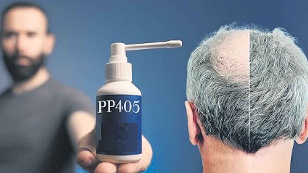 బట్ట తలకు బై బై!.. జుట్టు సహజంగా పెరిగేలా చేసే కొత్త మందు