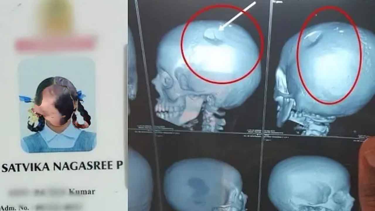 Skull Damage | అల్ల‌రి చేస్తోంద‌ని బాలిక త‌ల‌పై కొట్టిన ఉపాధ్యాయుడు.. చిట్లిపోయిన పుర్రె ఎముక‌