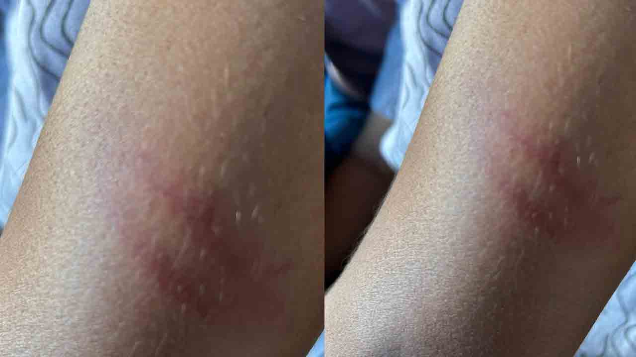 Suraram | పోలీసుల అత్యుత్సాహం.. వినాయకమడపం వద్ద యువకులపై లాఠీలతో దాడి