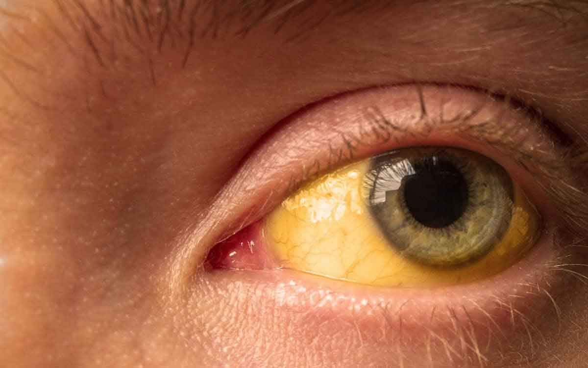 Yellow Eyes | మీ కళ్లు పసుపు రంగులోకి మారాయా..? అయితే కేవలం కామెర్లు మాత్రమే కాదు, ఇవి కూడా కారణాలు కావచ్చు..!