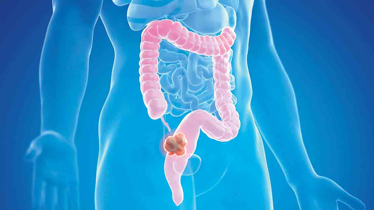 రక్తస్రావం ఉంటే పెద్ద పేగు క్యాన్సర్‌ రిస్క్‌ ఎక్కువ!