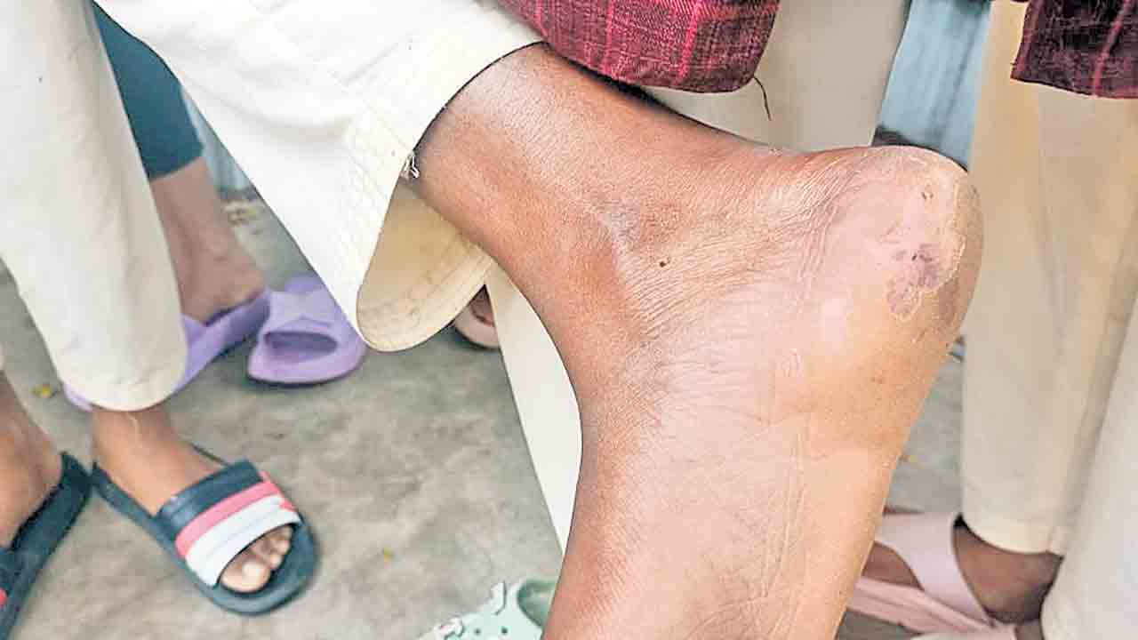 గిరిజన విద్యార్థినులను కరిచిన ఎలుకలు