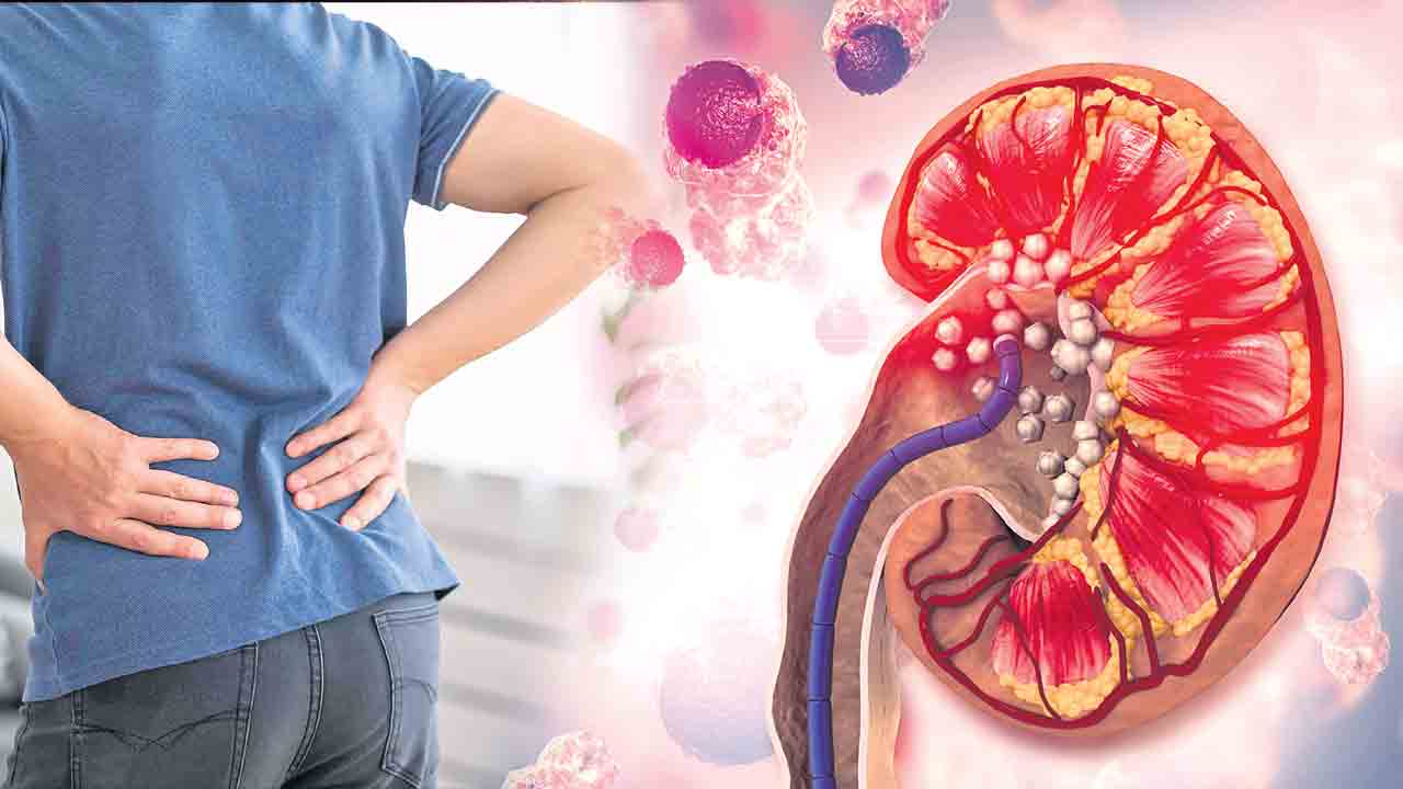 Kidney Stones | కిడ్నీ వ్యాధులపై నీళ్లు చల్లండి