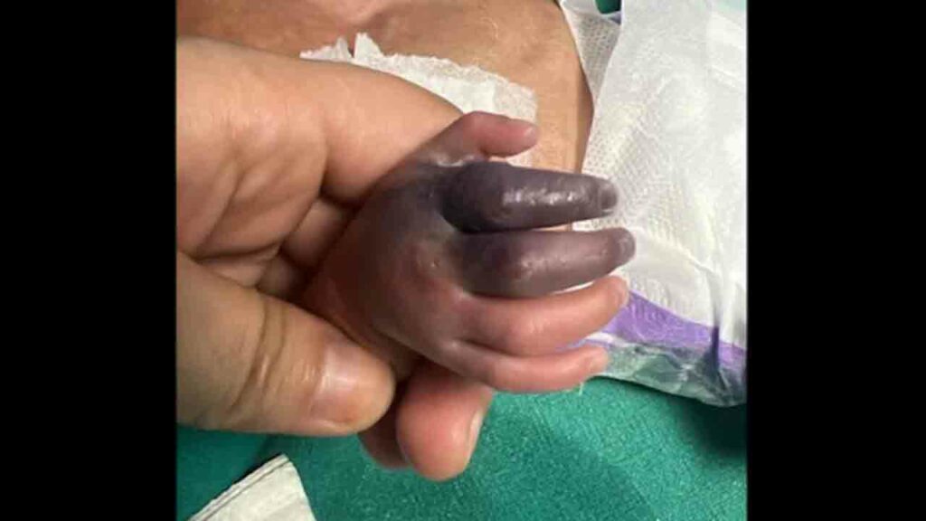 Newborn Set To Lose Hand