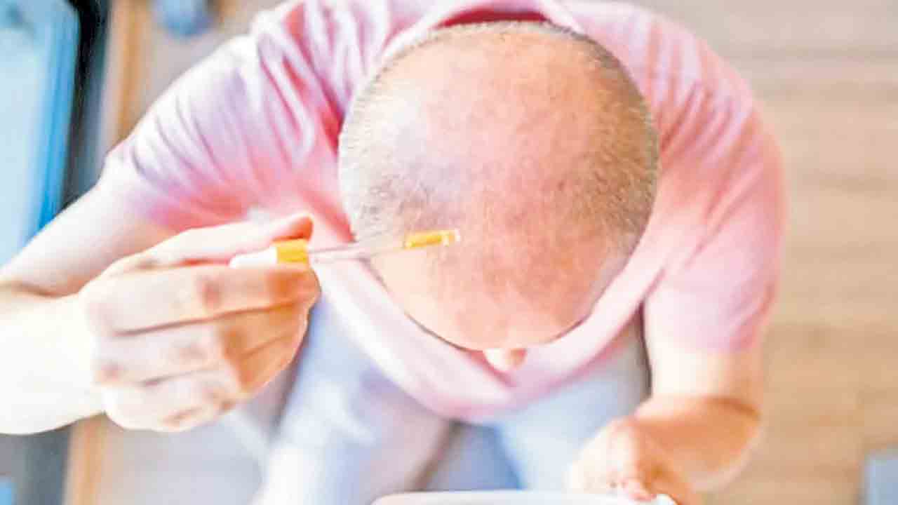 20 రోజుల్లో వెంట్రుకలను మొలిపించే సీరం!