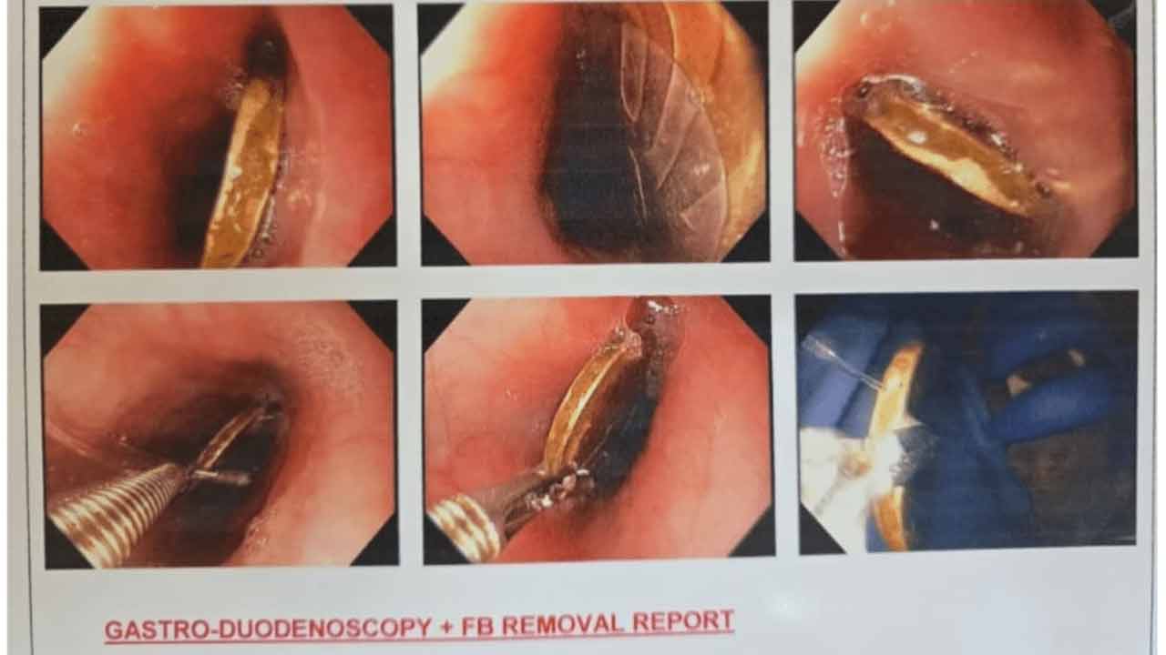 Rs 10 coin | బాలుడి ఆహార నాళంలో ఇరుక్కున్న రూ. 10 నాణెం..