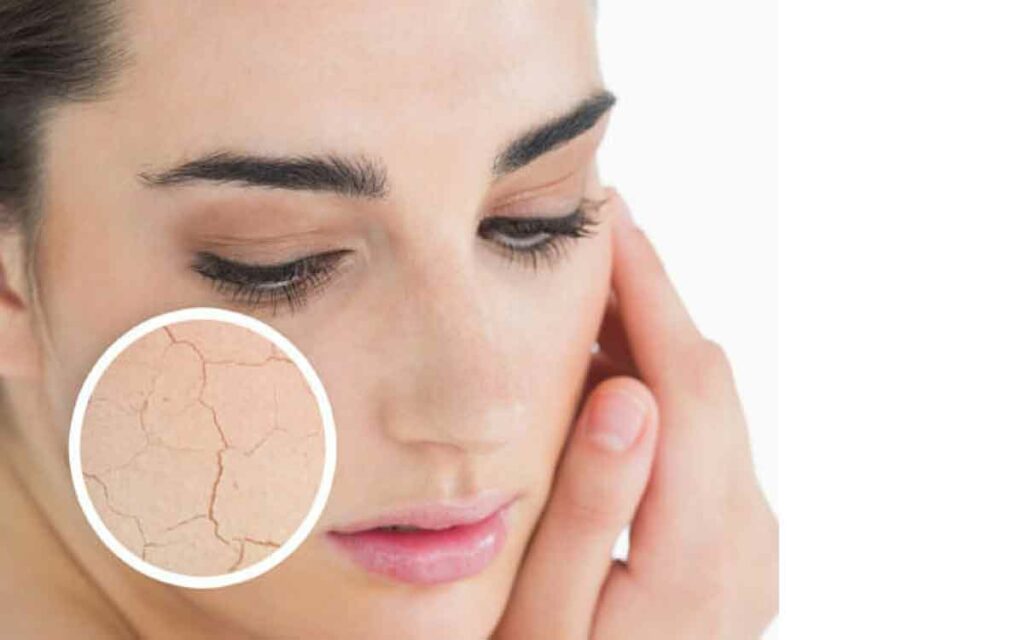 Dry Skin