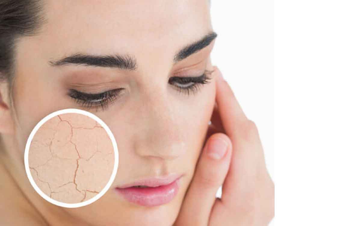 Dry Skin | చ‌ర్మం పొడిగా మారి బాగా ప‌గులుతుందా..? అయితే వీటిని రోజూ తినండి..!