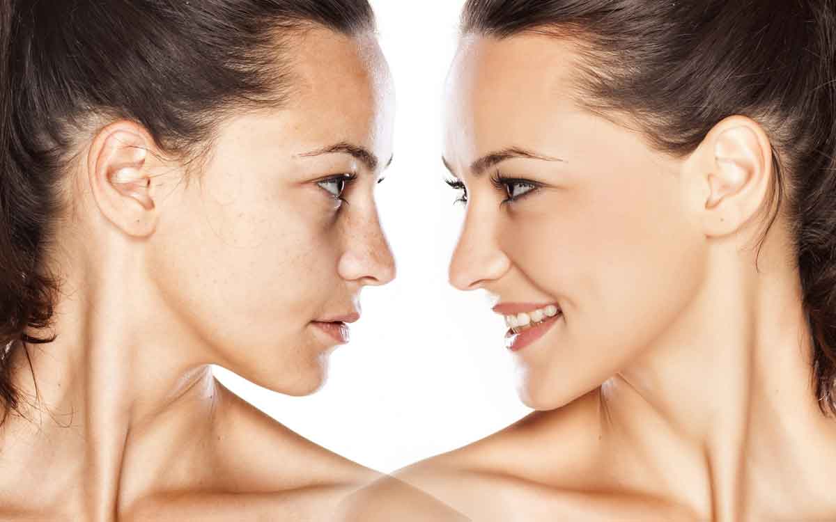 Facial Fat | మీ ముఖంలో కొవ్వు (ఫేషియల్ ఫ్యాట్) అధికంగా ఉందా..? అయితే ఇలా చేయండి, సమస్య తగ్గుతుంది..!