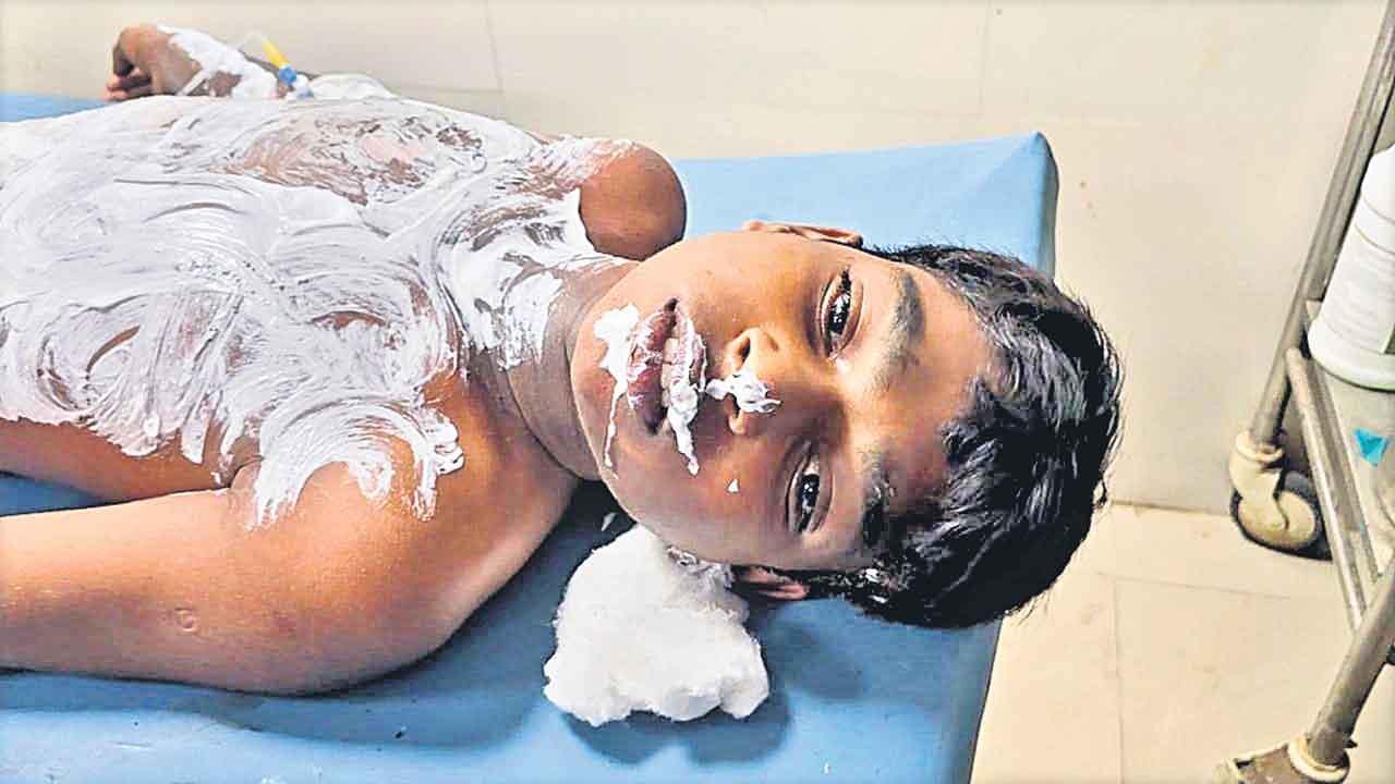 ట్రాన్స్‌ఫార్మర్‌ పేలి విద్యార్థికి తీవ్రగాయాలు