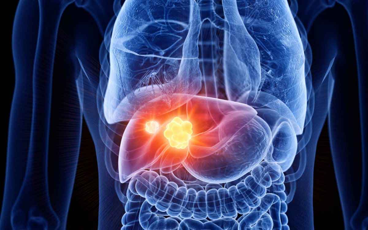Liver Cancer | లివర్ క్యాన్సర్ ఎందుకు వస్తుంది..? ఇది ఉంటే కనిపించే లక్షణాలు.. తీసుకోవాల్సిన ఆహారాలు..!