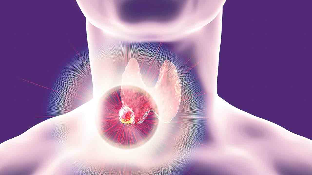 కోత పెట్టకుండా కణతి మాయం.. థైరాయిడ్‌ ట్యూమర్స్‌కు ఆధునిక చికిత్స