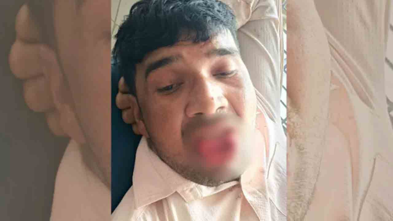 Ex-Girlfriend Bites Off Man’s Tongue | బలవంతంగా ముద్దు పెట్టేందుకు వ్యక్తి   యత్నం.. నాలుక కొరికిన మాజీ ప్రియురాలు