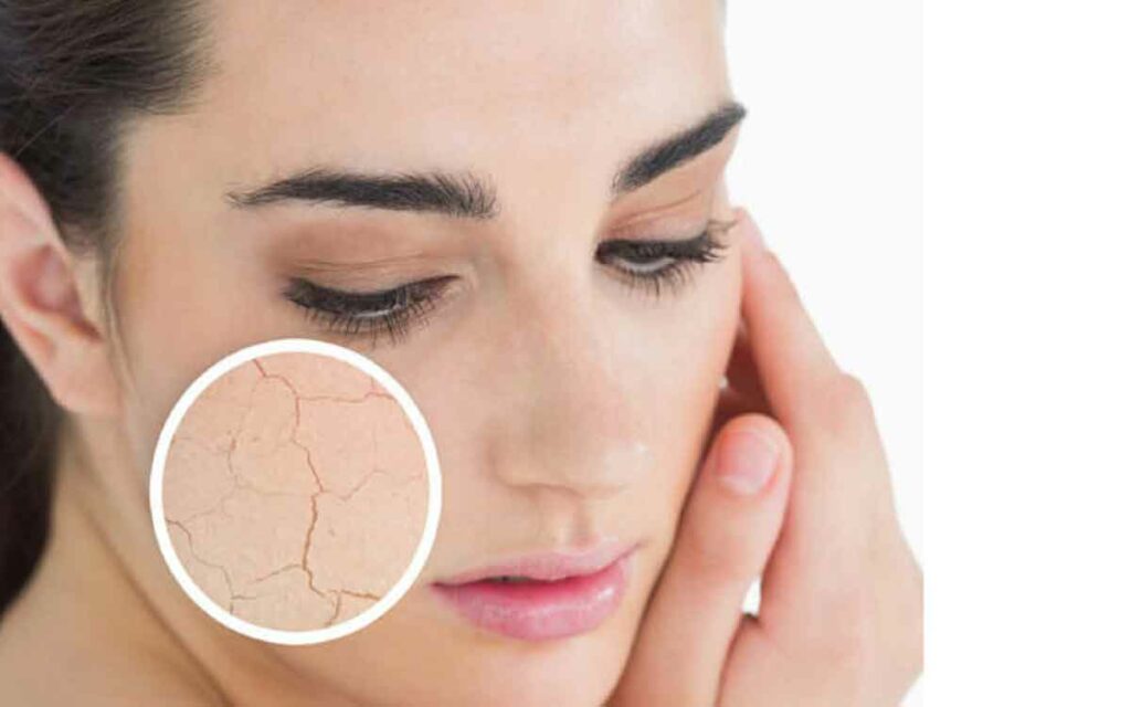 Dry Skin