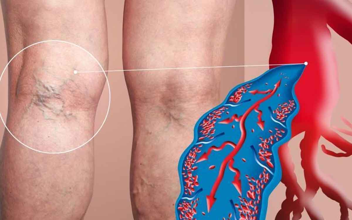 Blood Clotting | ర‌క్త నాళాల్లో ర‌క్తం గ‌డ్డ క‌ట్టే స‌మ‌స్య ఉందా..? అయితే రోజూ వీటిని తినండి.. ఎంతో మేలు జ‌రుగుతుంది..!