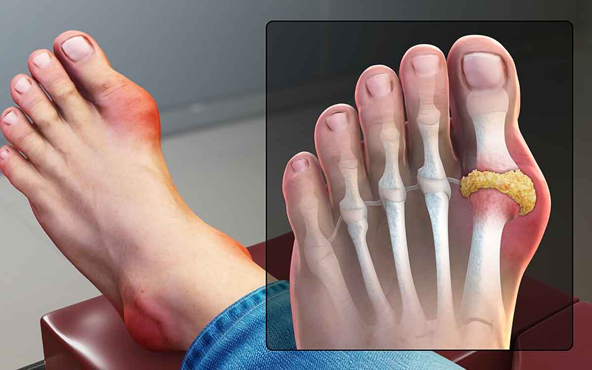 Gout | గౌట్ ఉన్న‌వారు పాటించాల్సిన చిట్కాలు.. యూరిక్ యాసిడ్ లెవ‌ల్స్ మొత్తం త‌గ్గిపోతాయి..