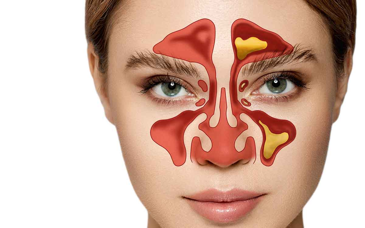 Sinusitis | సైన‌స్ స‌మ‌స్య ఉన్న‌వారు పాటించాల్సిన అద్భుత‌మైన చిట్కాలు.. ఎంతో రిలీఫ్ ల‌భిస్తుంది..