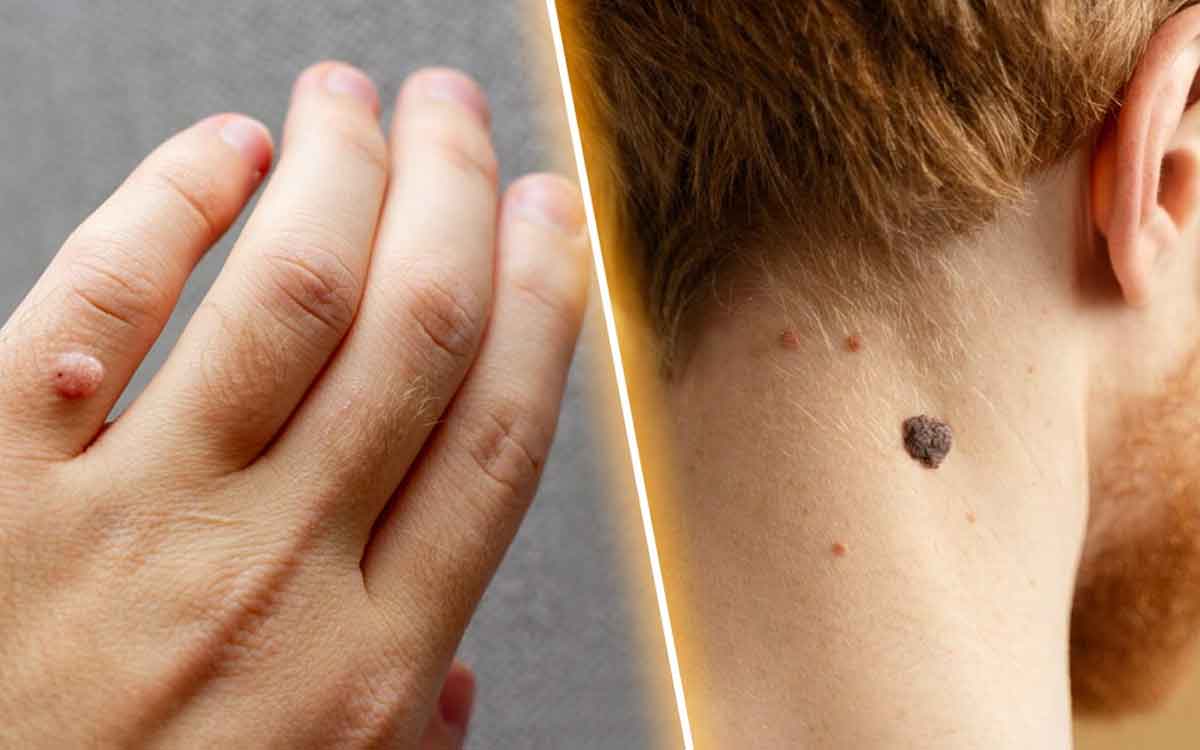 Warts | పులిపిర్లు అధికంగా వ‌చ్చి ఇబ్బంది ప‌డుతున్నారా..? అయితే ఈ స‌హ‌జ‌సిద్ధ‌మైన చిట్కాల‌ను పాటించండి..