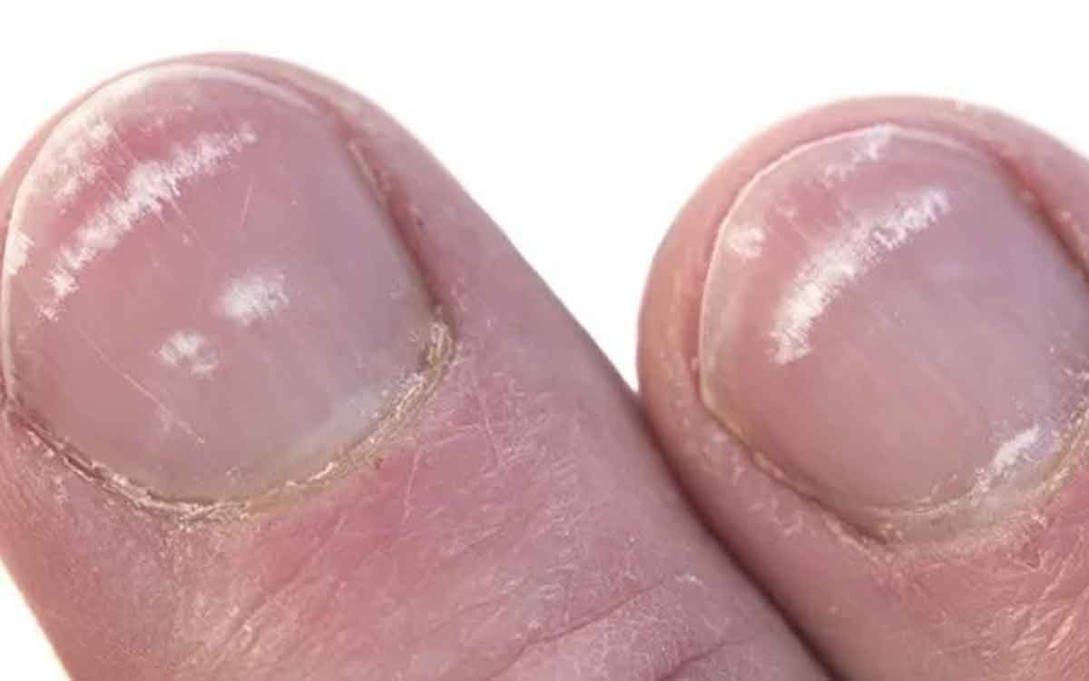 White Spots On Nails | మీ చేతి వేళ్ల గోర్ల‌పై ఇలా తెల్ల‌ని మ‌చ్చ‌లు ఉన్నాయా..? అయితే ఏం జ‌రుగుతుందో తెలుసా..?