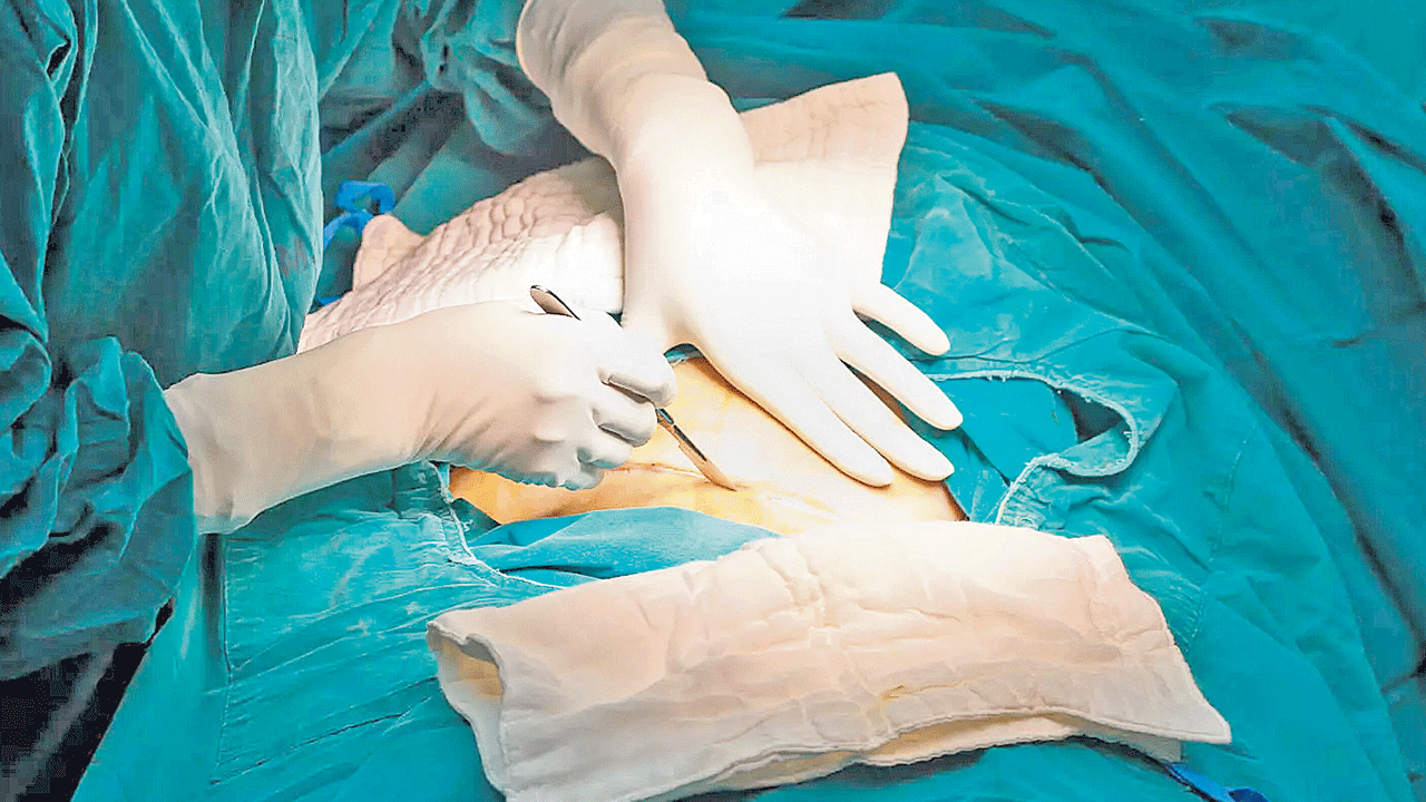 Cesarean | రాష్ట్రంలో 80% కడుపుకోతలే… కాంగ్రెస్‌ సర్కార్‌ నిర్లక్ష్యం, వసతుల లేమితో పెరుగుతున్న సిజేరియన్లు