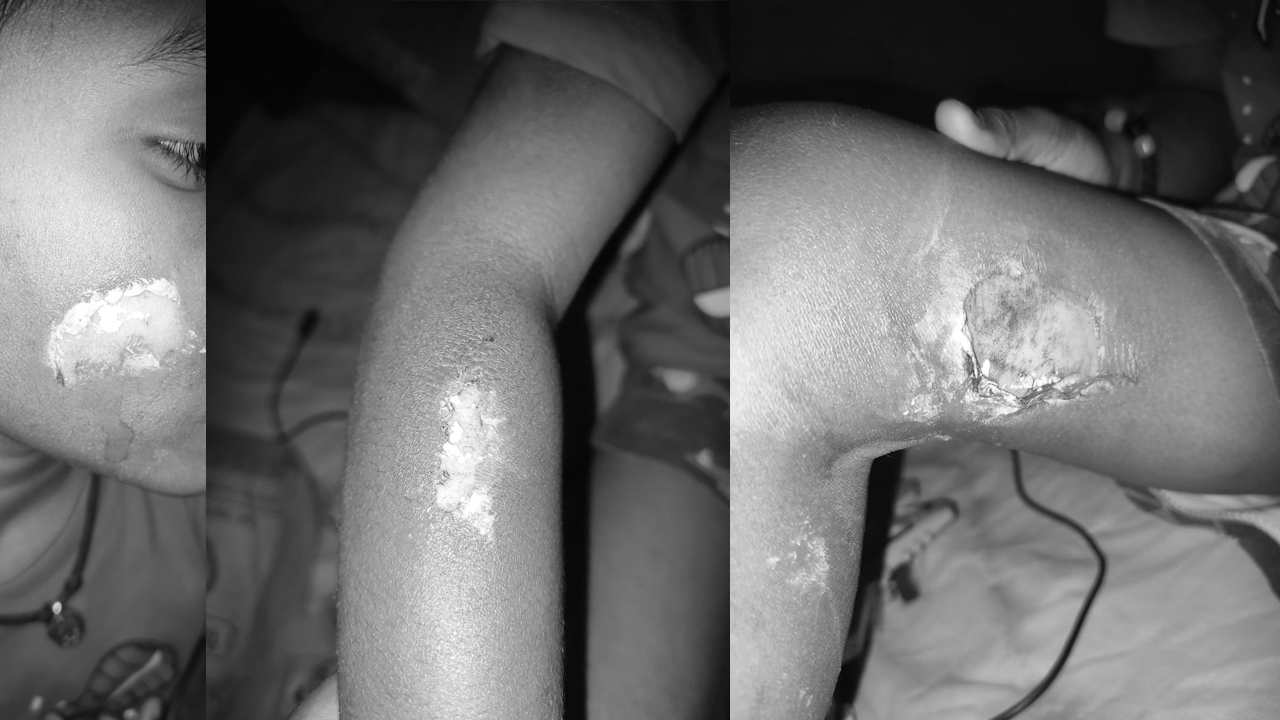 Tuition Teacher | అట్లకాడతో వాతలు.. చిన్నారిపై ట్యూషన్ టీచర్ దాష్టీకం