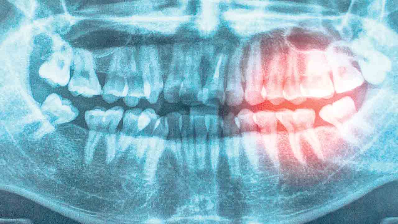 చిగుళ్ల సమస్యలు.. గుండె జబ్బుకు సంకేతాలు!